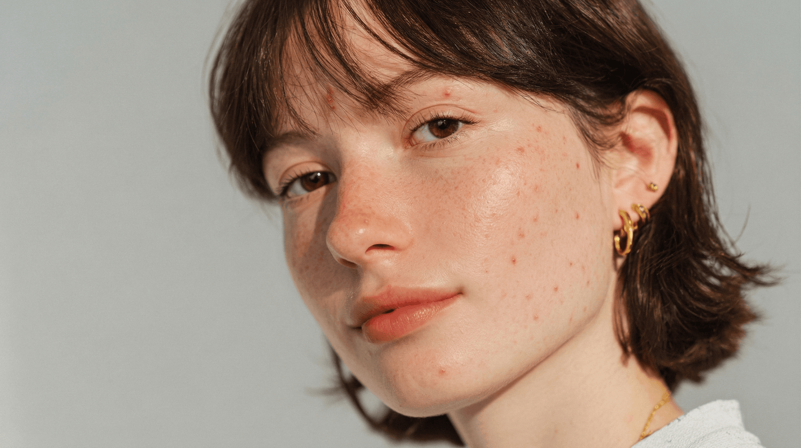How Acne Affects Piercings (Before, During, and After Healing)